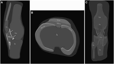 The Unexplored Role of Intra-articular Adipose Tissue in the Homeostasis and Pathology of Articular Joints